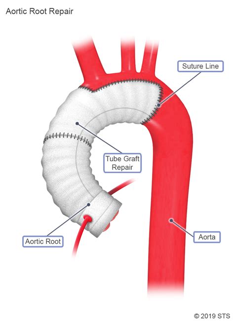 Thoracic Aortic Aneurysm - Newport Cardiac & Thoracic Surgery