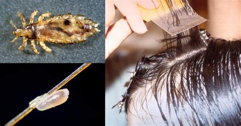 New guidance says children with head lice can stay in school | Health | abc12.com