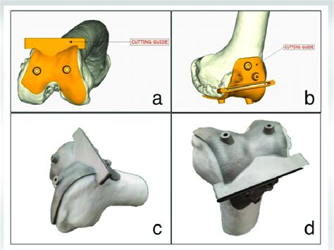 (a and b) software designing of Patient-Specific Instrument (PSI) using ...