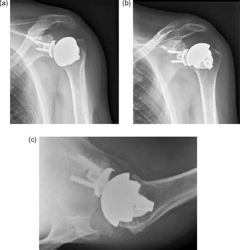 X-ray of left shoulder with total shoulder arthroplasty one year ...