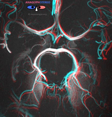 Anterior Choroidal Artery | neuroangio.org