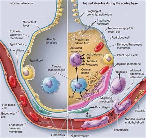 Cureus | Coronavirus (COVID-19) Fulminant Myopericarditis and Acute Respiratory Distress ...