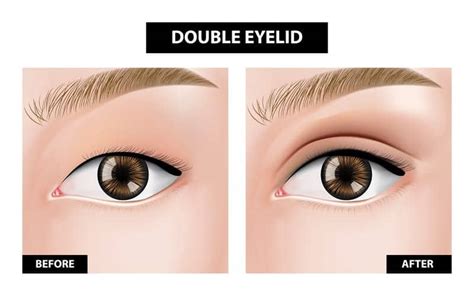 What Are Double Eyelids? - Plastic Surgery Practice