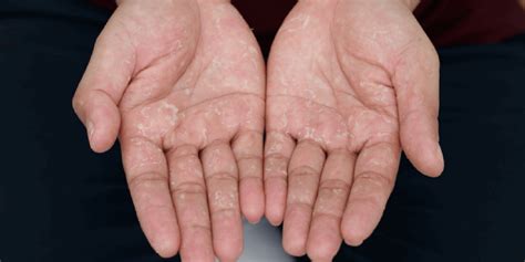 Dyshidrotic Eczema On Fingers Overview Causes Symptoms Treatment – NBKomputer