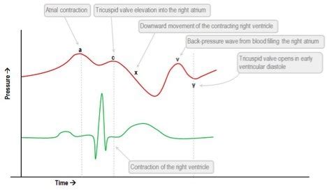 CVP waveform - INTENSIVE