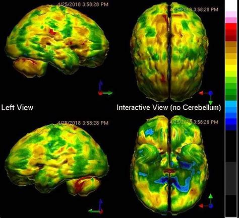 Pet Scan Brain Depression