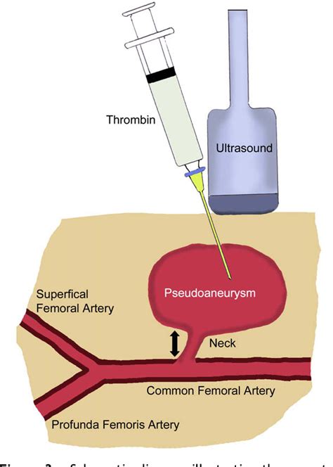 Figure 3 from Iatrogenic femoral artery pseudoaneurysms--a review of current methods of ...