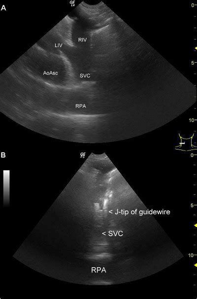 The Supraclavicular Fossa Ultrasound View for Central Venous Catheter Placement and Catheter ...