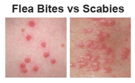 Flea Bites vs. Bed Bug Bites Pictures, Difference, How to Tell, Symptoms on Humans, Sand Flea ...