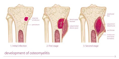 كشف التهاب العظم والنقي Osteomyelitis شعاعياً - موقع فكين