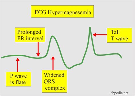 Hypomagnesemia Ecg