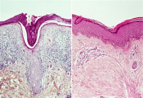 PAH Prognosis Affected by Connective Tissue Disease-PAH Etiology - MPR