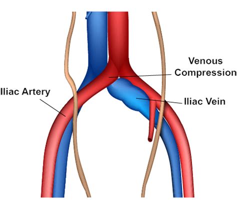 Deep Vein Thrombosis Treatment Macon, Locust Grove, Warner Robins, GA | Vein Specialists of the ...