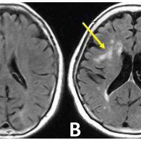 Typical MRI of G0 (right panel) and G2 (left panel; arrows indicate... | Download Scientific Diagram