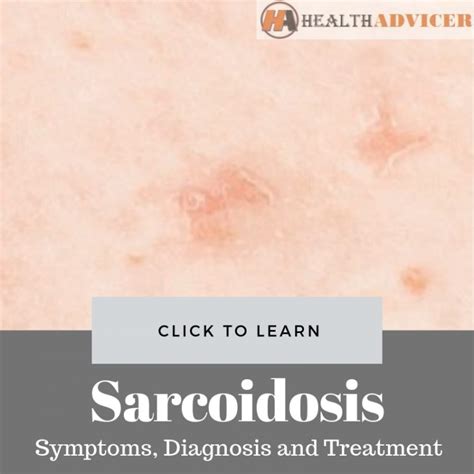 Sarcoidosis: Symptoms, Picture, Diagnosis And Treatment