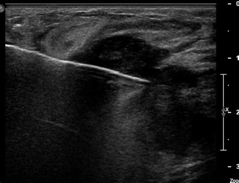 Percutaneous Biopsy – Undergraduate Diagnostic Imaging Fundamentals