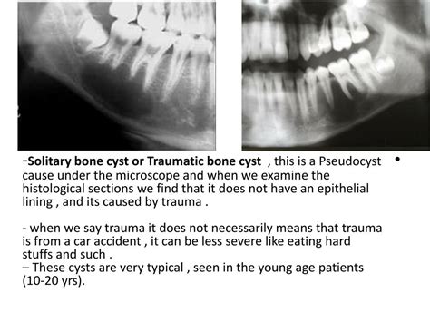 PPT - Cysts of the jaw PowerPoint Presentation, free download - ID:3012372