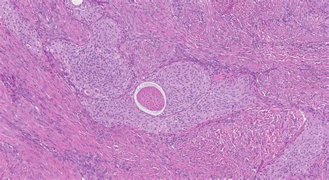 Goedaardige Brenner-tumor | MyPathologyReport.ca