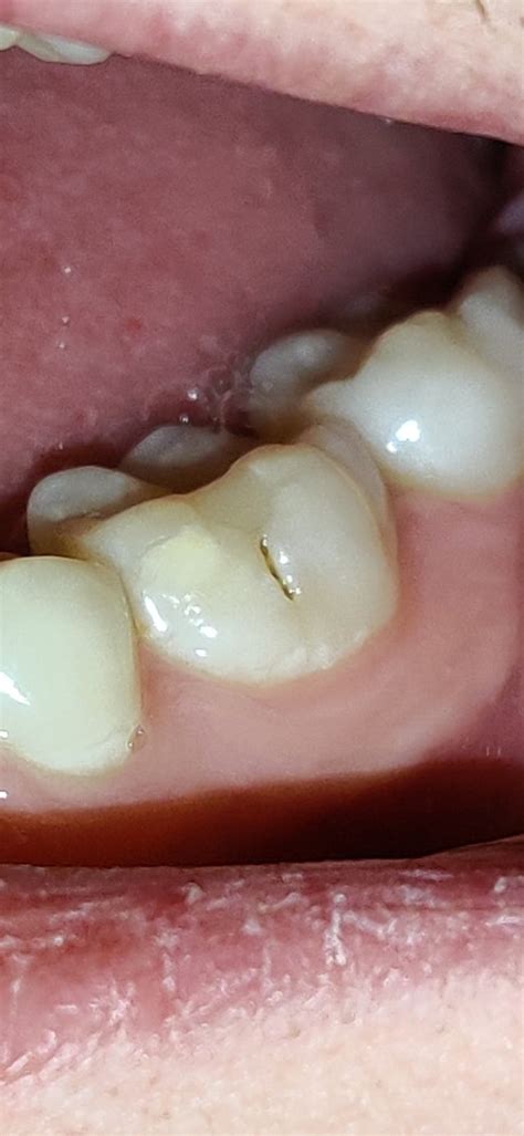 I just noticed a strange dark spot on my tooth, is it tooth decay? : r/Dentistry