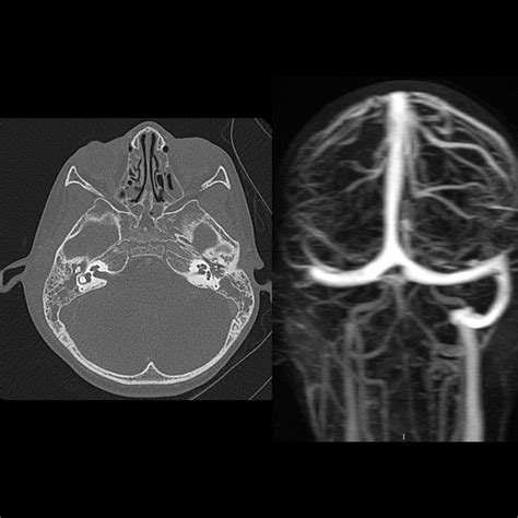 Venous Sinus Thrombosis Ct Head | SexiezPicz Web Porn