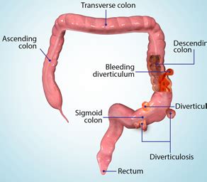 Diverticular Disease Dallas, TX | Colostomy Dallas, TX