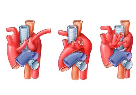 Expertise in the nuances of diagnosis, management and surgery for vascular rings - Mayo Clinic