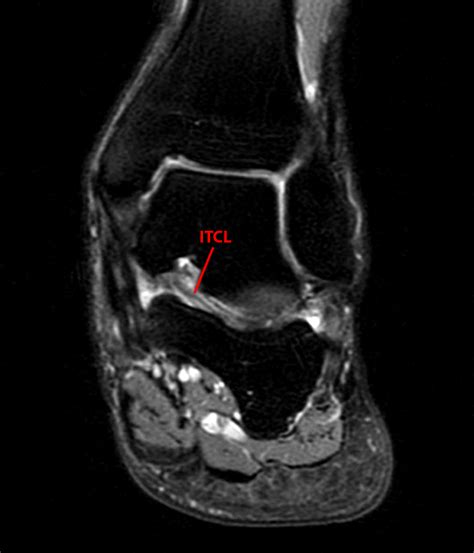 Sinus Tarsi Syndrome Mri