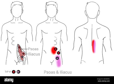 Psoas and Iliacus: Myofascial trigger points and associated pain ...