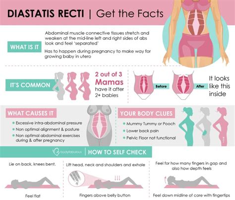 How to measure your Diastatis Recti / Abdominal Separation | BodyFabulous Pregnancy Women's Fitness