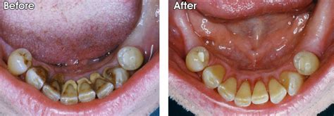 Dental scaling; Scaling, Dental; Root Scaling; Scaling, Subgingival; Scaling, Supragingival ...