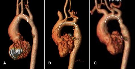 Morphological variations of the aortic arch in patients following ...