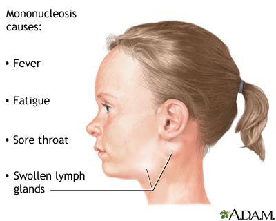 Infectious mononucleosis: MedlinePlus Medical Encyclopedia Image