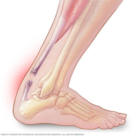 Achilles tendon rupture - Symptoms and causes - Mayo Clinic