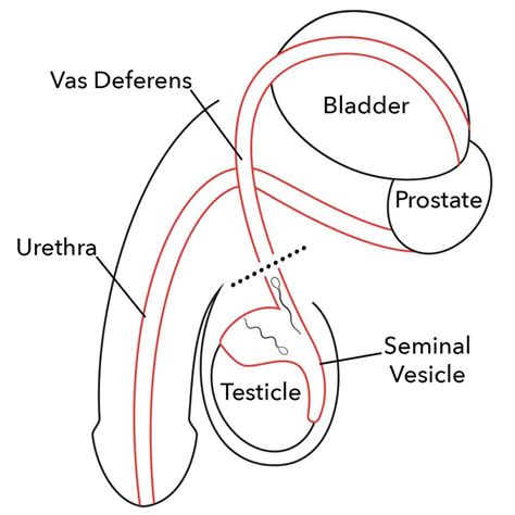 Merrillville vasectomy