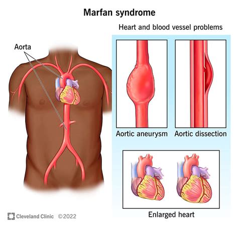 Marfan Syndrome: Causes, Symptoms, Diagnosis & Treatments