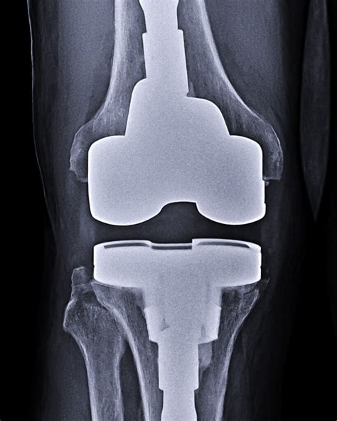 Infected Knee Replacement – ADAM SASSOON M.D., M.S.