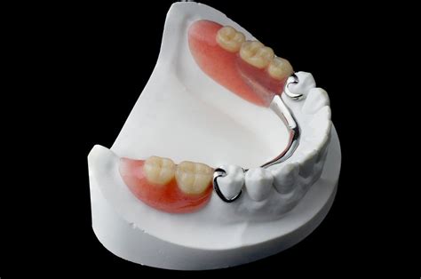 Partial Dentures - Dental Visions Family Dentistry