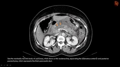 Ultimate Radiology : Acute Necrotizing Pancreatitis