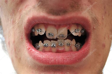 Close up of crooked teeth with braces — Stock Photo © vlue #4626241