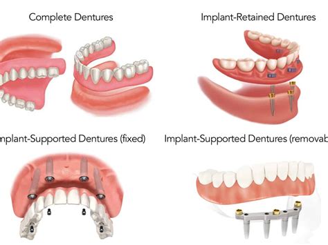 same day permanent dentures near me - Shawnda Pennell