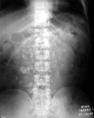 Gastrointestinal Tuberculosis Imaging: Practice Essentials, Esophageal Tuberculosis, Gastric and ...