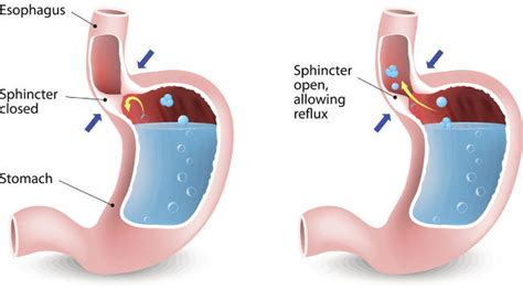 How To Use Baking Soda To Treat And Prevent Acid Reflux