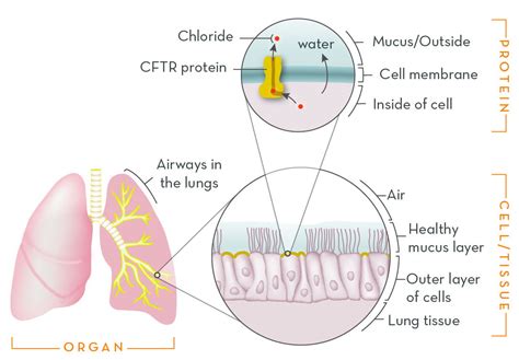 Cystic Fibrosis