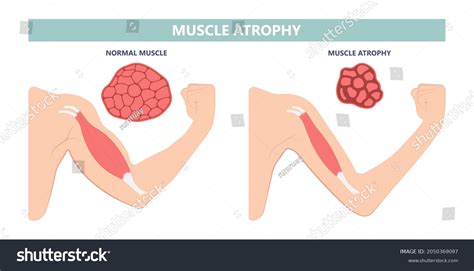 600 Muscle Atrophy Images, Stock Photos & Vectors | Shutterstock