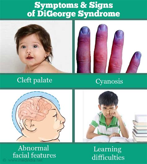 Digeorge Syndrome Cardiac Defects