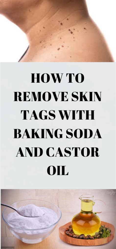 How to Remove Skin Tags With Baking Soda and Castor Oil | Skin tag ...