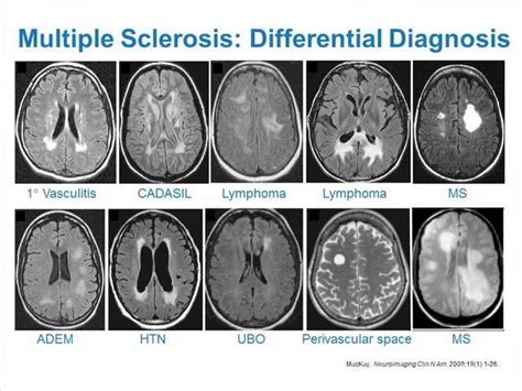 ms symptoms but normal mri - Captions Definition