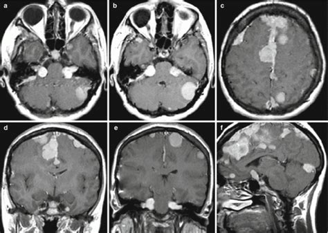 Hemangiopericytoma | Radiology Key