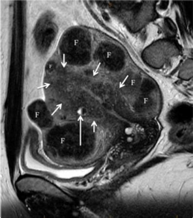 How to Diagnose Adenomyosis? Why are we missing it? - Sydney Fibroid Clinic