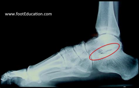 Subtalar Arthritis - FootEducation